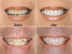 before-after-cosmetic-dentistry