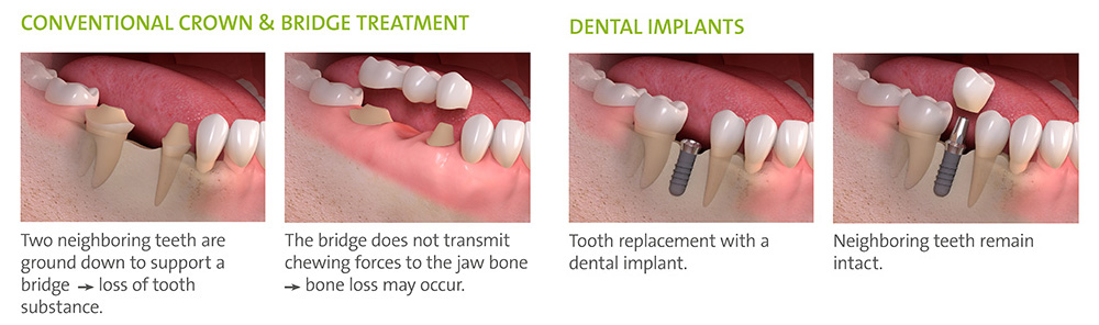 bridge_or_implant