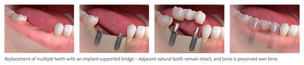 implant_supported_multi_tooth_2