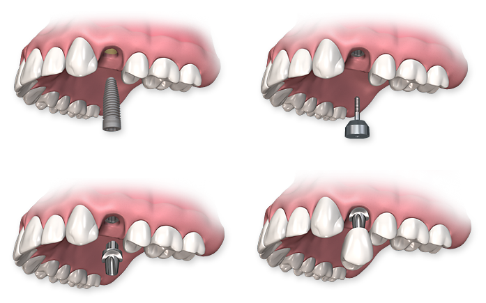 single-dental-implant-procedure