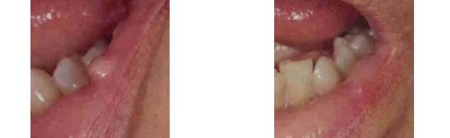 Before and after laser treatment